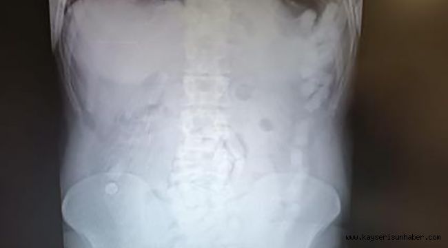 Midesinden 100 kapsül uyuşturucu çıktı