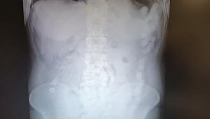 Midesinden 100 kapsül uyuşturucu çıktı