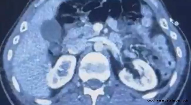 Ülkeye midelerinde uyuşturucu getiren şahıslar yakalandı