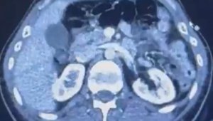 Ülkeye midelerinde uyuşturucu getiren şahıslar yakalandı